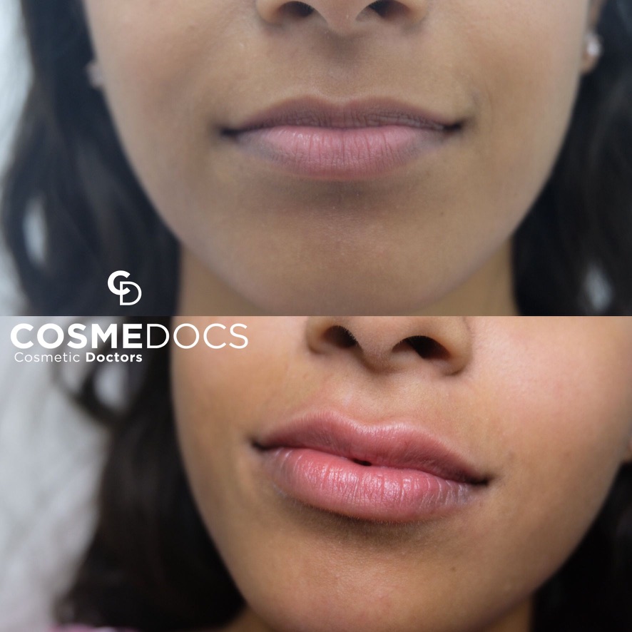 Lip filler before and after showing natural enhancement