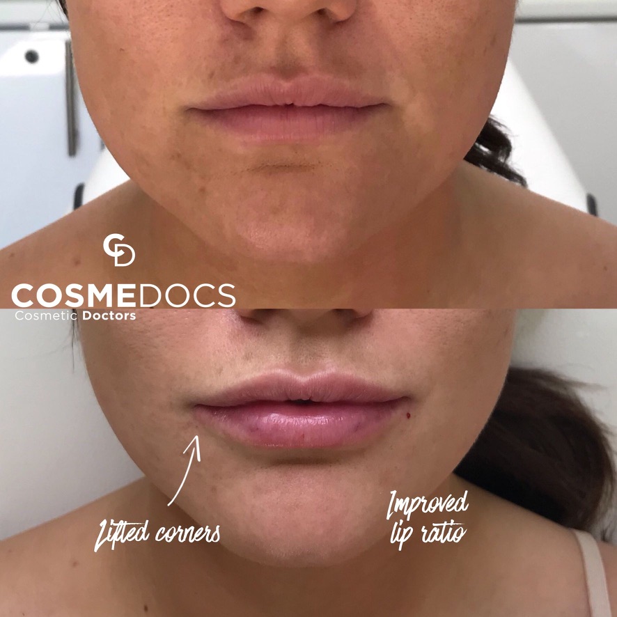 Lip filler before and after showing lifted corners and improved lip ratio