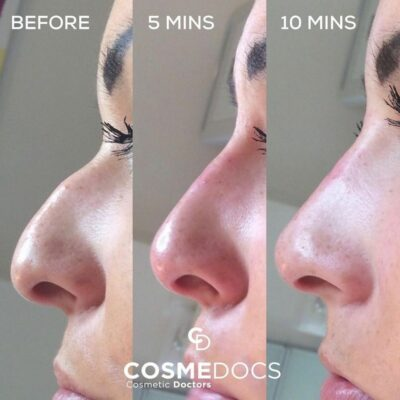 Non-surgical nose job progression showing before, 5 minutes and 10 minutes after treatment