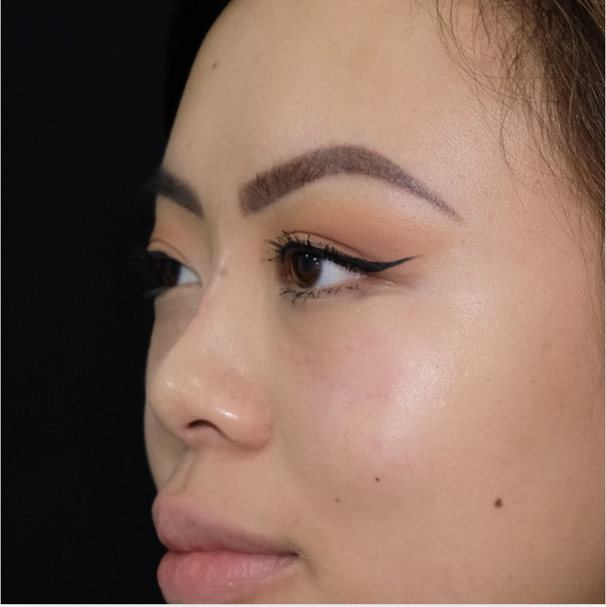 Asian nose reshaping after non-surgical rhinoplasty showing enhanced bridge and profile
