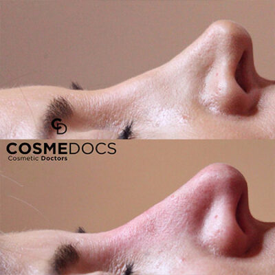 Nasal bridge smoothing before and after non-surgical nose job