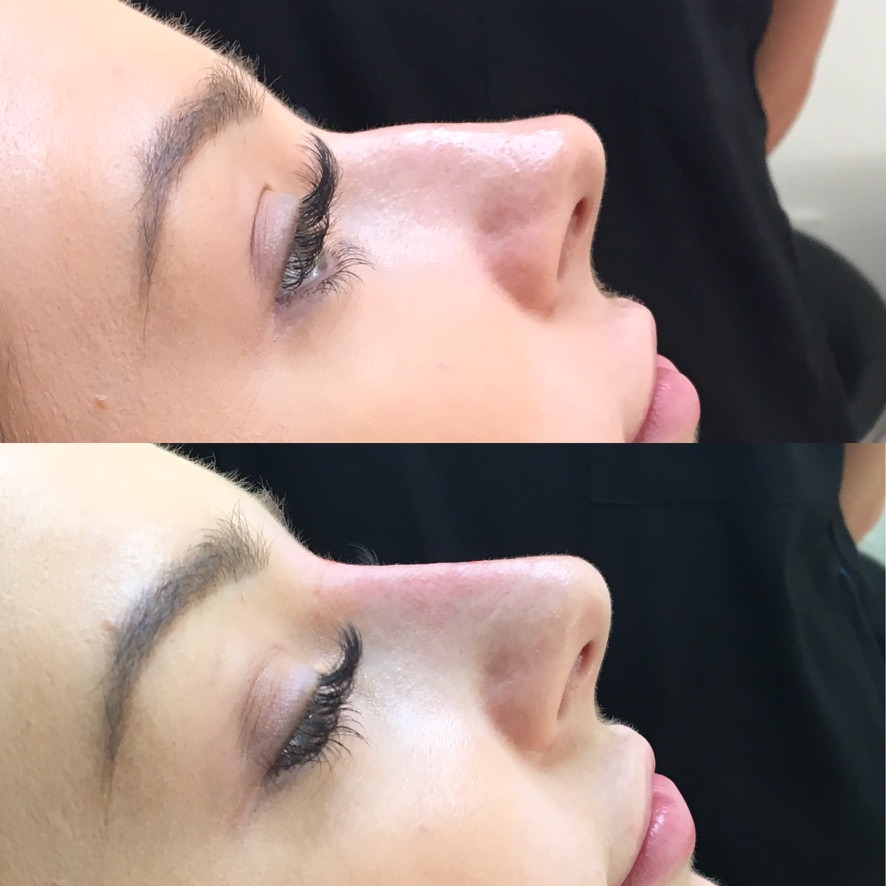 Non-surgical nose job before and after showing dorsal hump camouflage in female patient