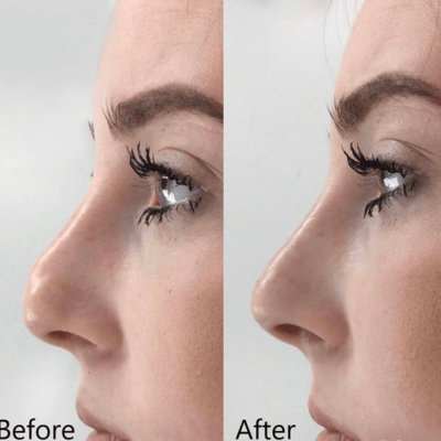 Dorsal smoothing profile before and after nose filler treatment