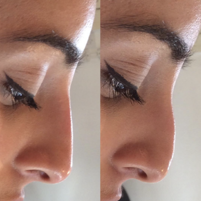 Ethnic nose bridge refinement before and after non-surgical rhinoplasty