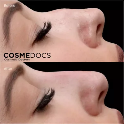 Female nasal bridge contouring before and after non-surgical nose job