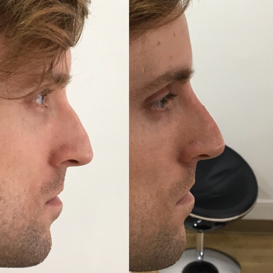 Male non-surgical rhinoplasty before and after showing profile refinement