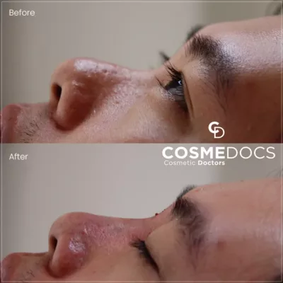 Male nose underside correction before and after showing improved contour from below