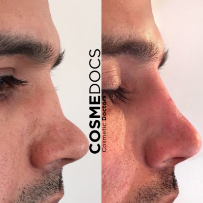 Post-surgical rhinoplasty correction using dermal filler before and after