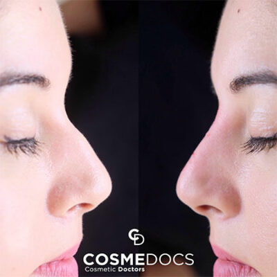 Nose profile silhouette before and after non-surgical rhinoplasty