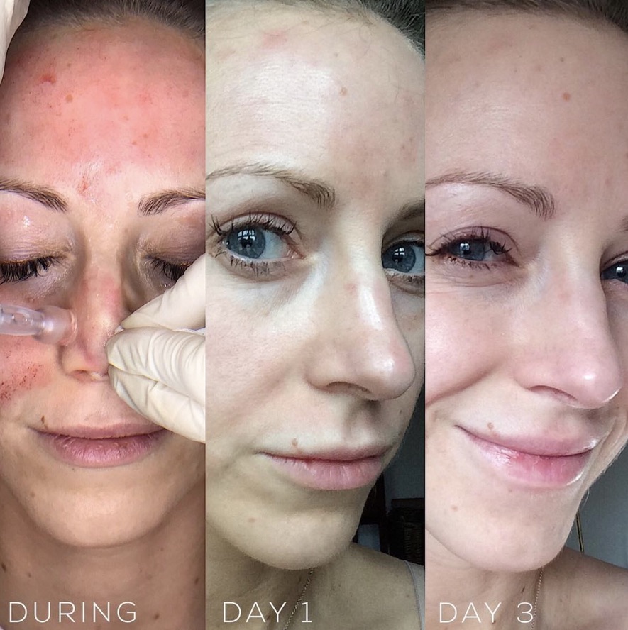 Microneedling treatment progression showing during, day 1, and day 3 results