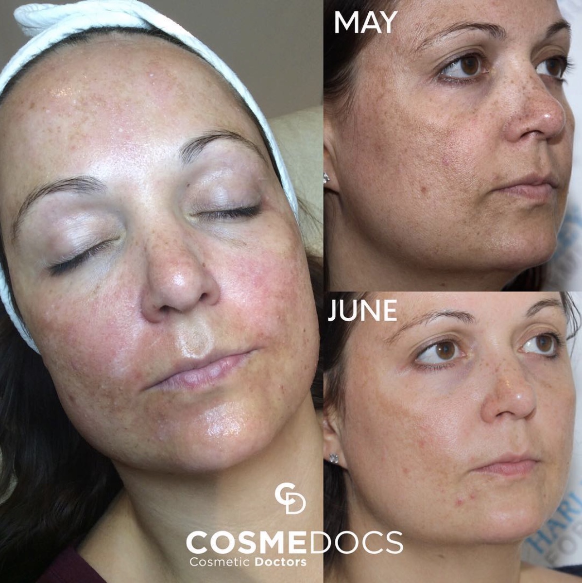Cosmedocs skin treatment results showing May to June improvement
