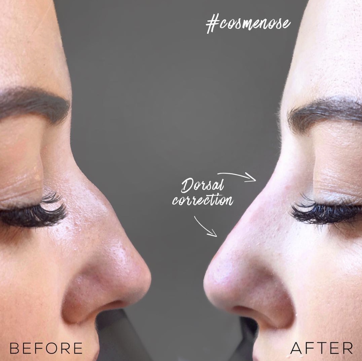 Dorsal nose correction before and after non-surgical nose job